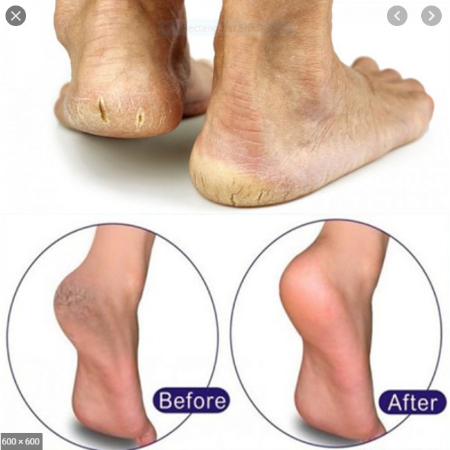 Kem Trị Nứt Gót Chân Kpem Apteka Nga | BigBuy360 - bigbuy360.vn