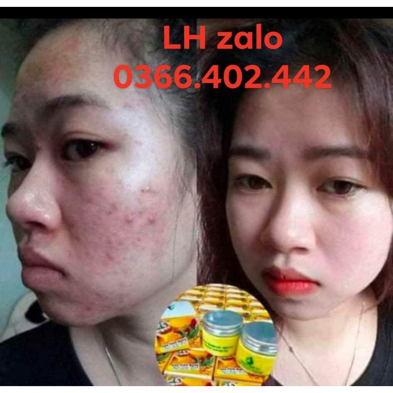 Cao Tinh Nghệ - Mặt nạ ngủ, Trắng hồng da, mờ thâm, nám, tàn nhang, se lỗ chân lông, giảm mụn mới