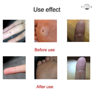 100 Miếng dán mụn cóc , mụn cơm hiệu quả