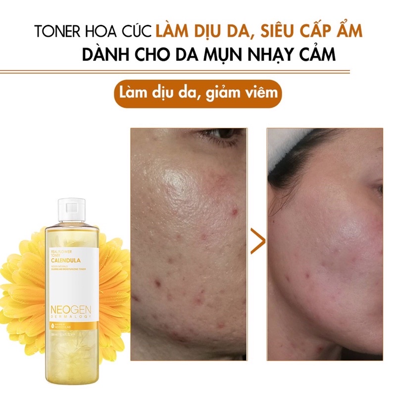 Toner hoa cúc cấp ẩm dành cho da mụn Neogen Dermalogy 300ml