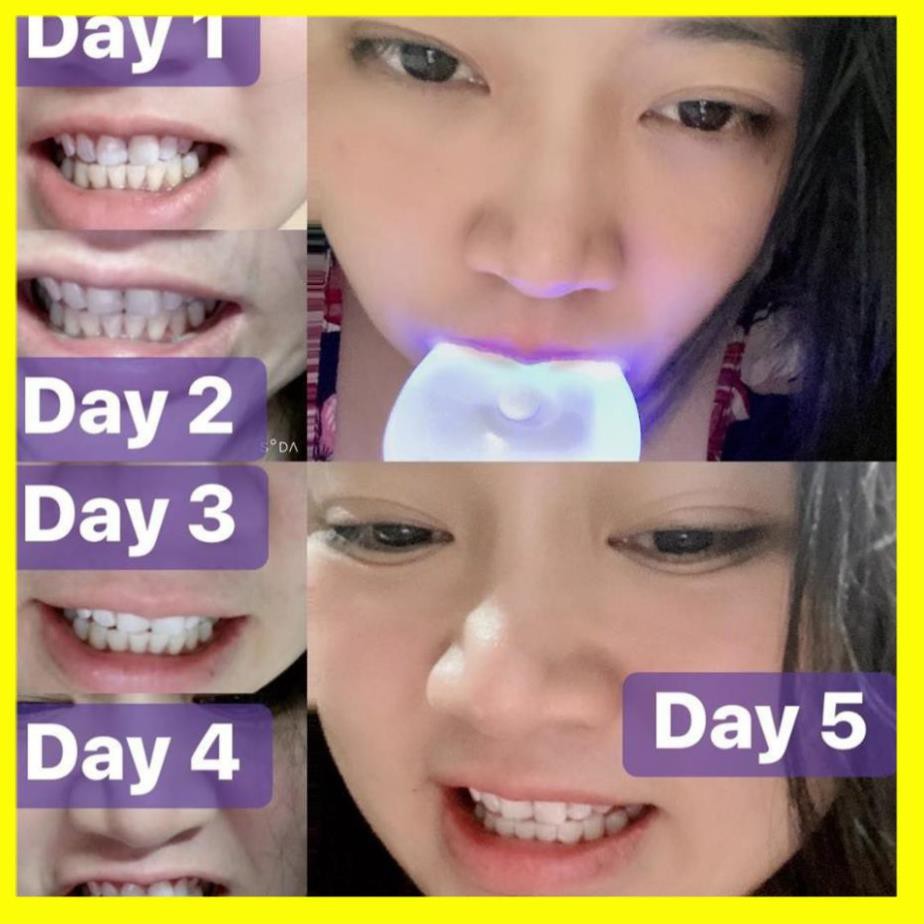 [ Hàng ÚC] Máy làm trắng răng bằng ánh sáng xanh White Glo White Accelerator Blue Light Teeth Whitening System