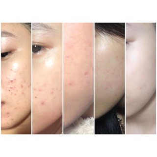 [CHÍNH HÃNG] Megaduo gel mụn, thâm mụn