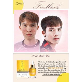 Gel mụn keo ong