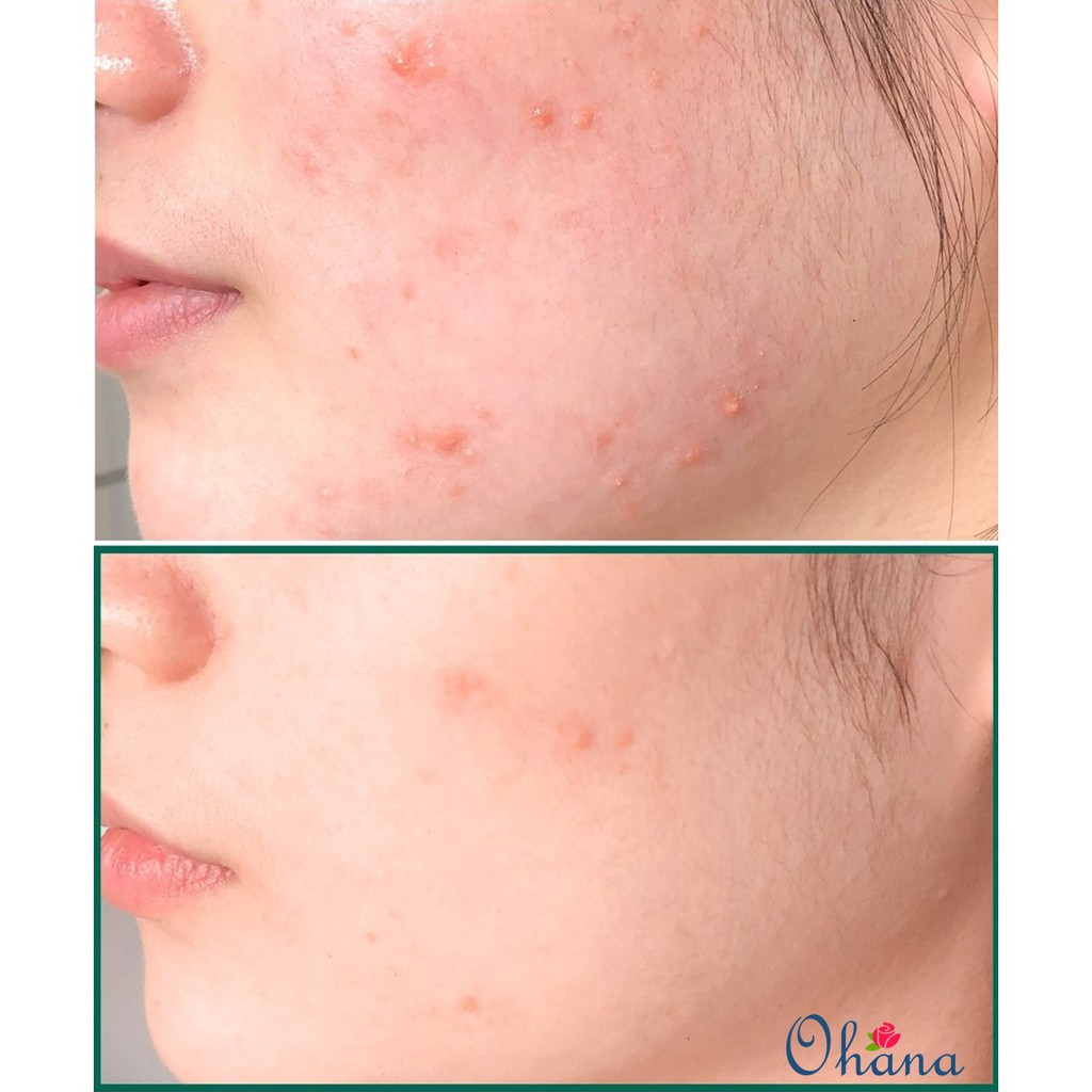 Sữa Rửa Mặt Làm Giảm, Ngăn Ngừa Mụn Some By Mi AHA-BHA-PHA 30 Days Miracle Acne Clear Foam 100ml | BigBuy360 - bigbuy360.vn