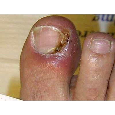 Thảo Dược Bôi Hết Sạch Đẹp #Nấm#Viêm# Móng Tay, Móng Chân