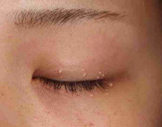 Kem trị mụn thịt số 1 nhật bản