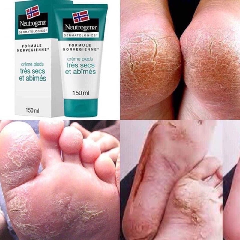 KEM NỨT GÓT VÀ NẺ CHÂN NEUTROGENA 150ml.