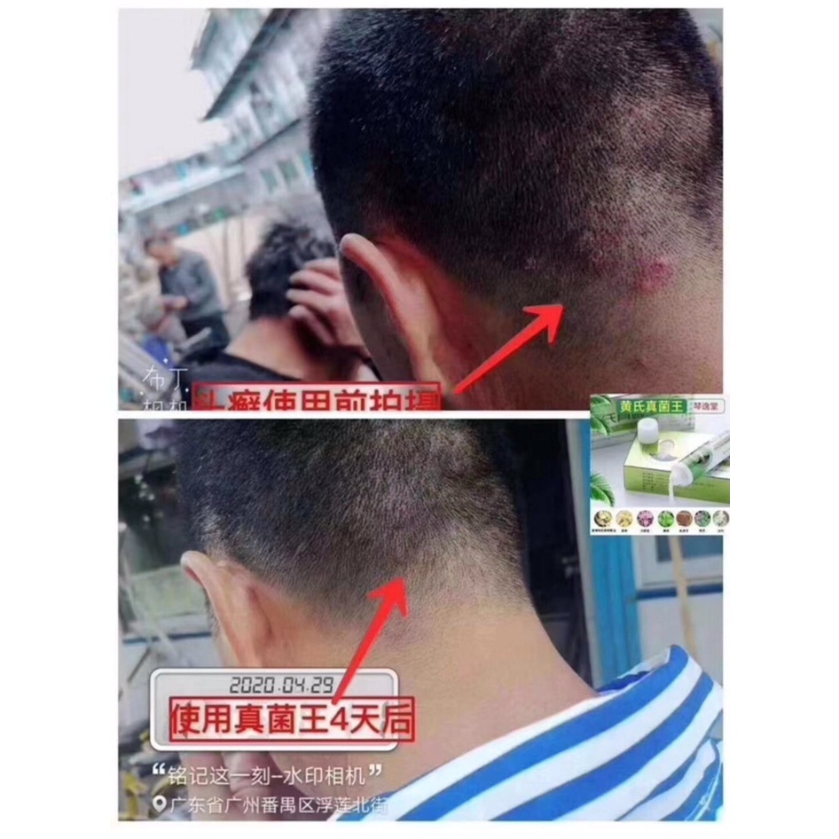 Kem bôi vẩy nến nấm đầu mẩn đỏ hăm ta chàm sữa