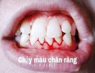 Kem đánh trắng răng