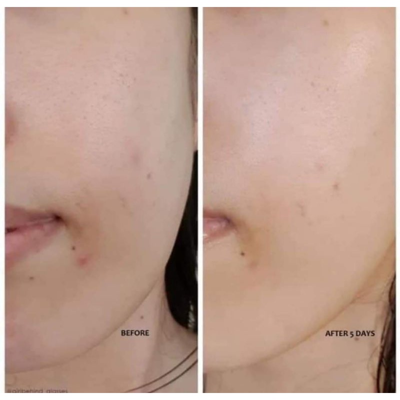Kem dưỡng diếp cá cho da nhạy cảm, dầu mụn derma factory