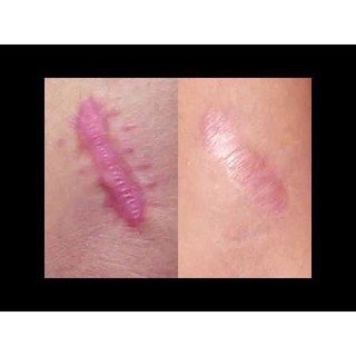 Miếng dán Scar fx 2.5x10cm chuẩn mỹ