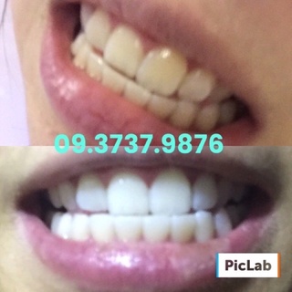 Bộ ngậm trắng răng Brighter White