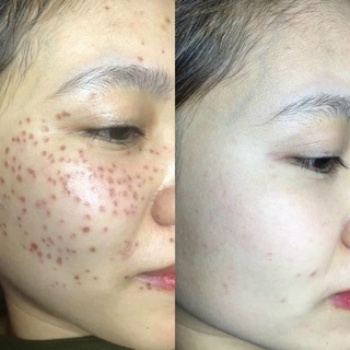 TCA 50% chấm tàn nhang, sẹo rỗ, nốt ruồi 2ml