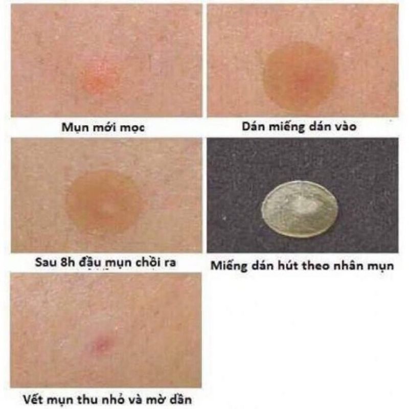 Miếng dán mụn Duoderm extra thin, miếng dán hút mủ chăm sóc da, chăm sóc vết thương