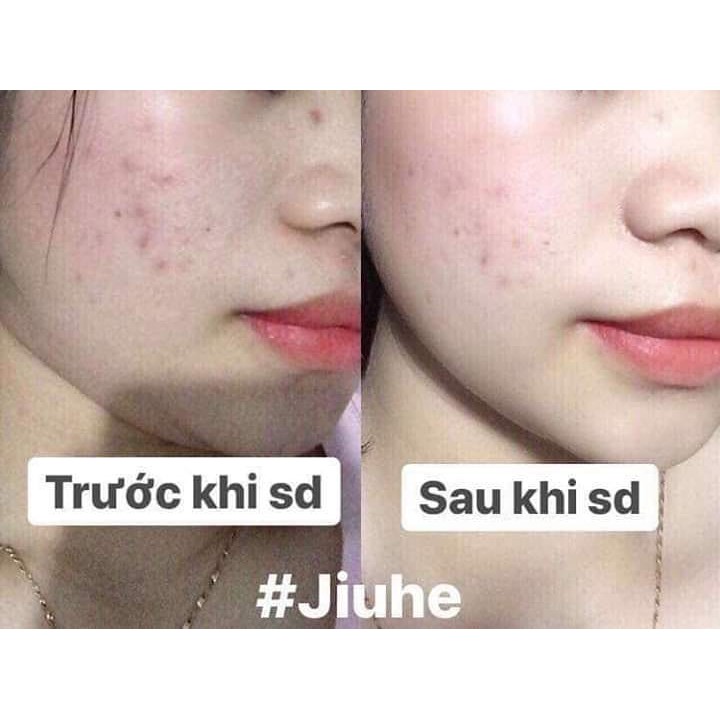 Tinh chất giảm thâm Jiuhe | BigBuy360 - bigbuy360.vn