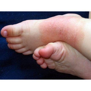 Thảo Dược Bôi Hết Sạch Nổi mẩn, Ửng đỏ, Ngứa gãi ở mặt, tay, chân, toàn thân ngoài da (Đông Y Cổ Truyền)