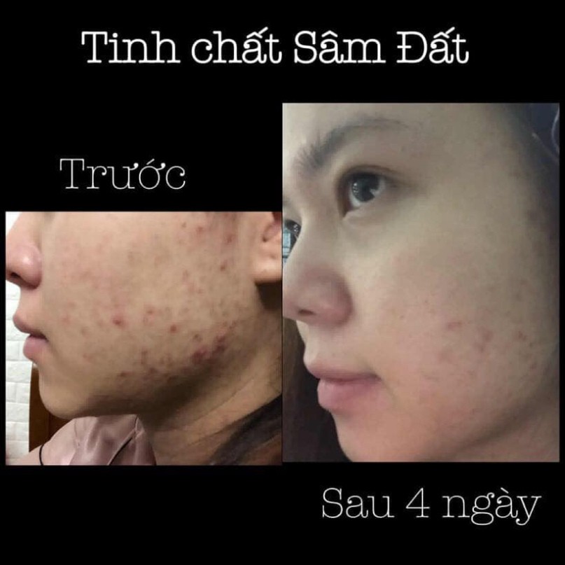 Tinh Chất Sâm Đất, Đánh Bay Mụn Nhanh Chong, Tái Tạo Da, Giảm Thâm, Se Khích Lỗ Chân Lông, 50ml Chính Hãng | BigBuy360 - bigbuy360.vn