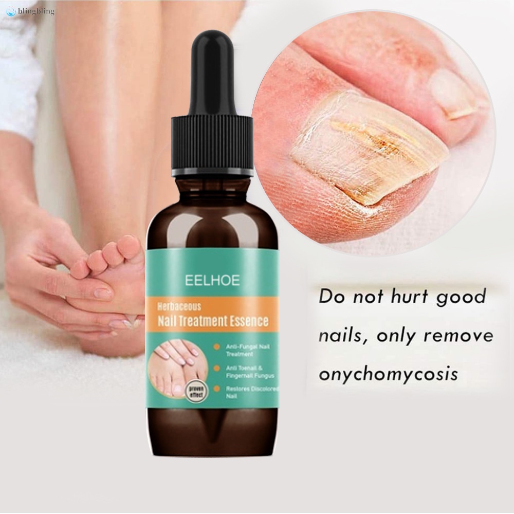 Tinh Chất Hỗ Trợ Giảm Bệnh Nấm Móng Tay Móng Chân Dung Tích 10ml 30ml