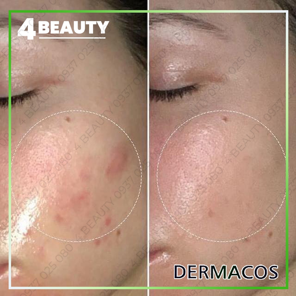 Kem Dưỡng Dermacos Anti-Acne Matting Cream 50Ml - Giảm nhờn, ngừa mụn