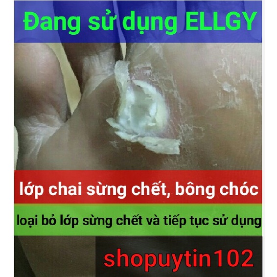 Ellgy Đánh Bay Mụn Cóc, Mụn Cơm, Mắt Cá Chân, Ké, Vết Chai, Chăm Sóc Da, Dưỡng Da Mềm Mại Trở Lại