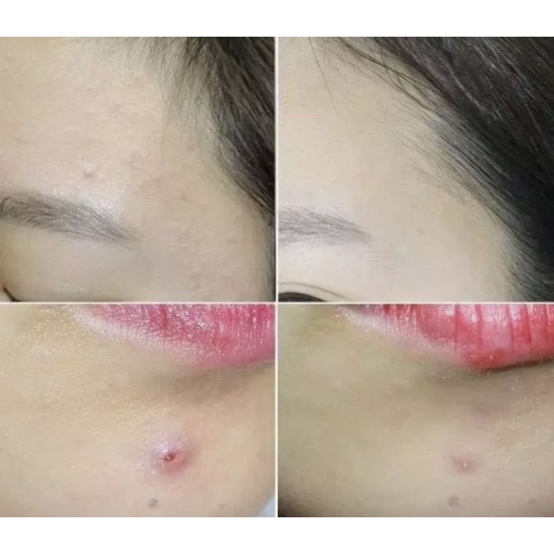 【Từ tp Hồ Chí Minh gửi hàng】Kem Giảm Mụn Chuyên Biệt Lion Pair 24g hỗ trợ cải thiện mụn trứng cá, mụn bọc, mụn viêm không để lại sẹo, xóa mờ vết thâm do sẹo để lại