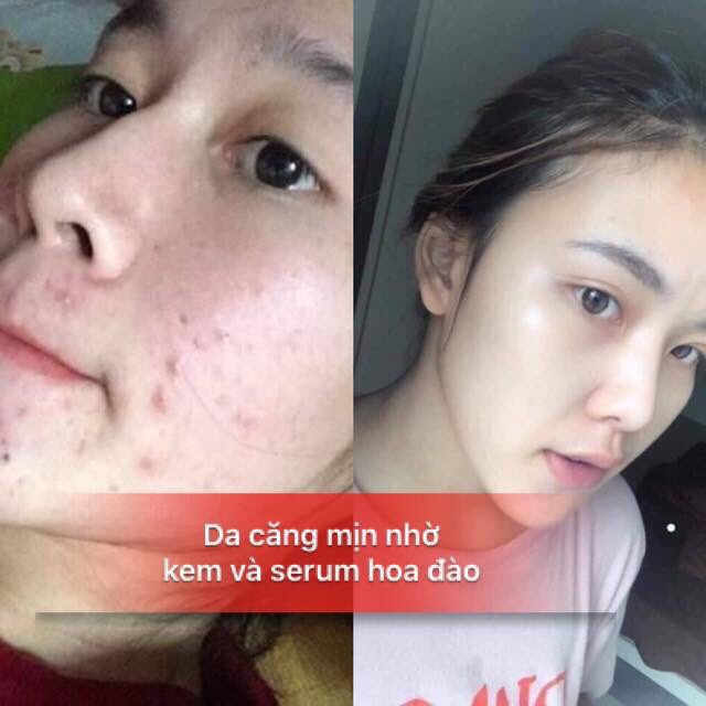 Kem Mụn Dưỡng Da Hoa Đào Full size