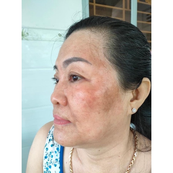 Kem đông y tái tạo hết sạch mụn nám | BigBuy360 - bigbuy360.vn