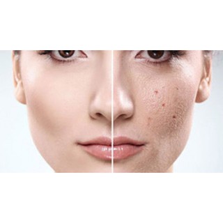 Con Lăn Trẻ hóa da Trị sẹo Derma Roller System