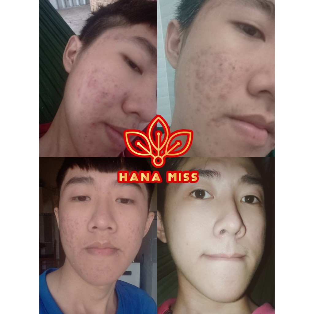 [DEAL SỐC] Serum xoá mụn giảm mụn - HANA MISS 🚫CAM KẾT KHÔNG HẾT MỤN HOÀN TIỀN🚫 | BigBuy360 - bigbuy360.vn