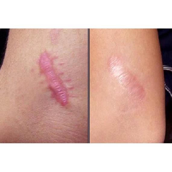 Sẹo Lồi - Sẹo Lõm - Sẹo Rỗ Lâu Năm | BigBuy360 - bigbuy360.vn