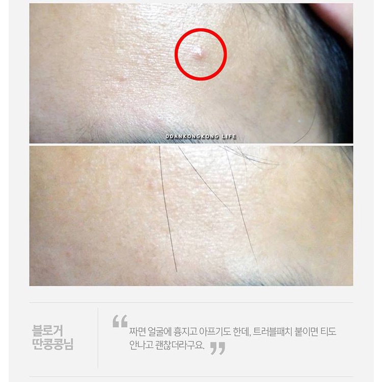 Miếng Dán Hỗ trợ giảm mụn Chăm Sóc Da Mặt ACROPASS
