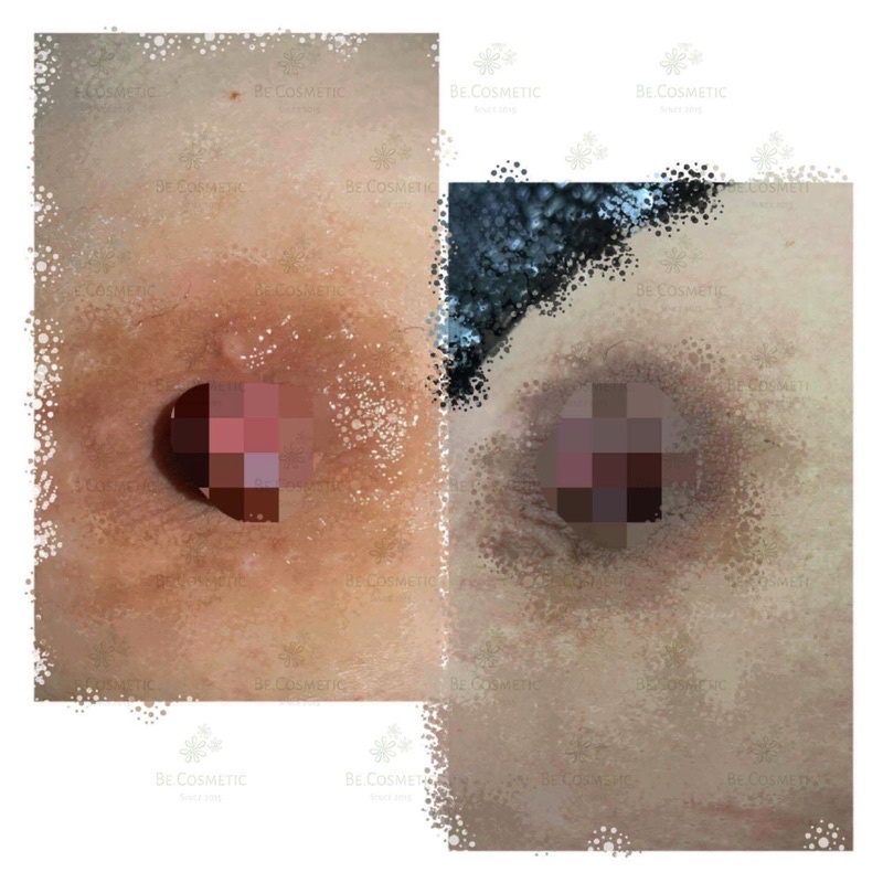 Kem dưỡng hồng nhũ hoa & bikini | BigBuy360 - bigbuy360.vn