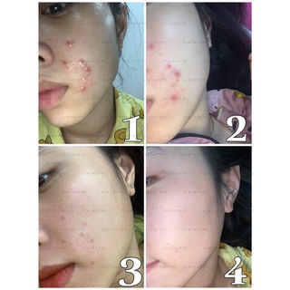 SERUM GIẢM MỤN THÂM VAURORA