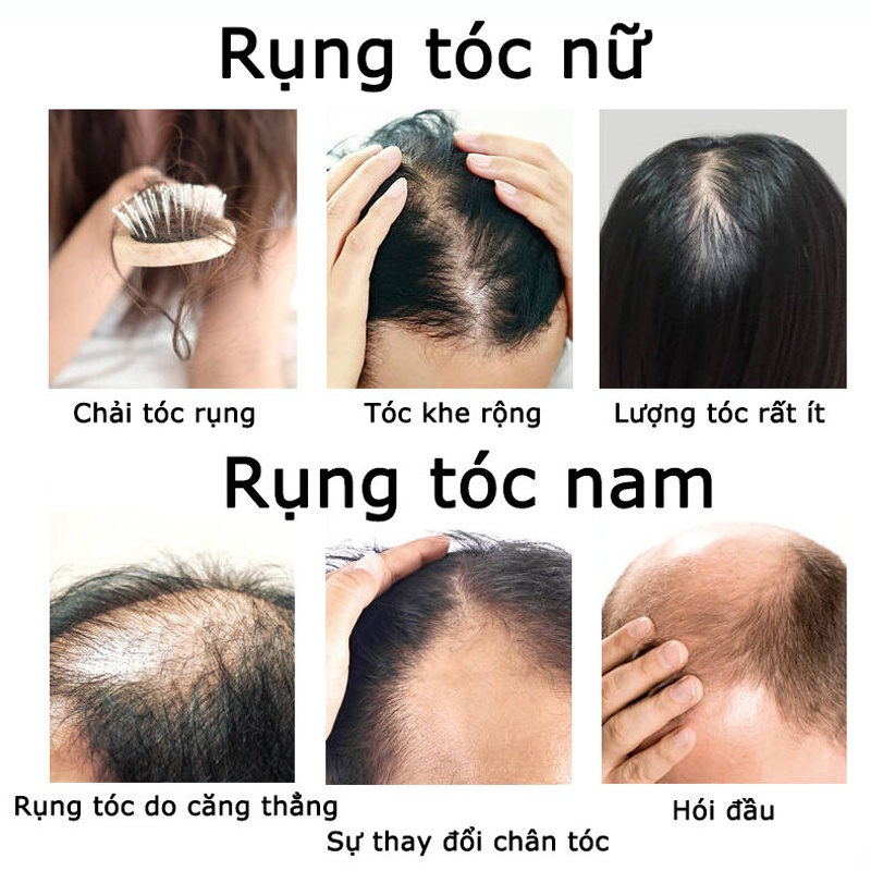 Bộ dầu gội ngăn rụng tóc dầu gội chống rụng tóc chết xuất gừng tươi có thể kích mọc tóc nhanh