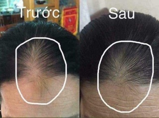 XỊT MỌC TÓC genive thái lan