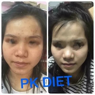 Kem tan mỡ mặt Vline PK Diet