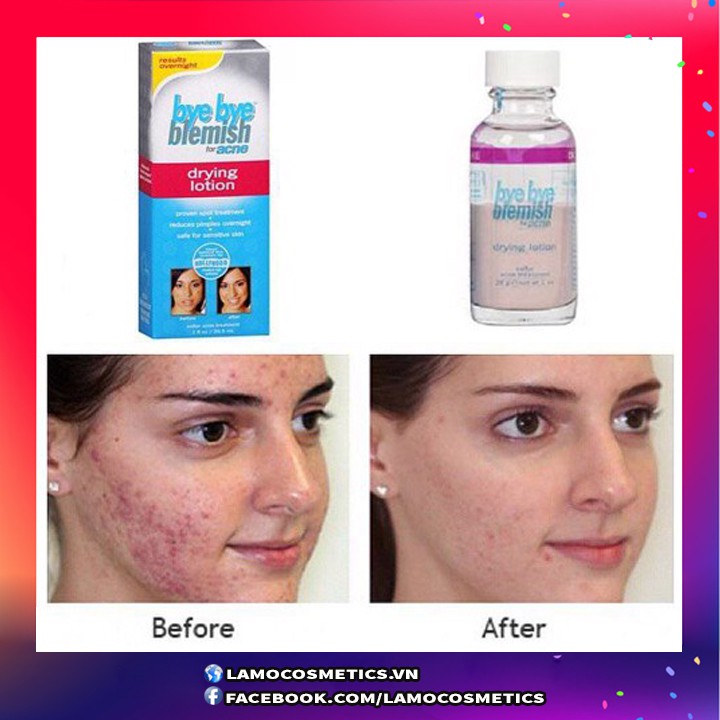 Chấm Mụn Bye Bye Blemish For Acne Drying Lotion USA Chính Hãng 100% | BigBuy360 - bigbuy360.vn