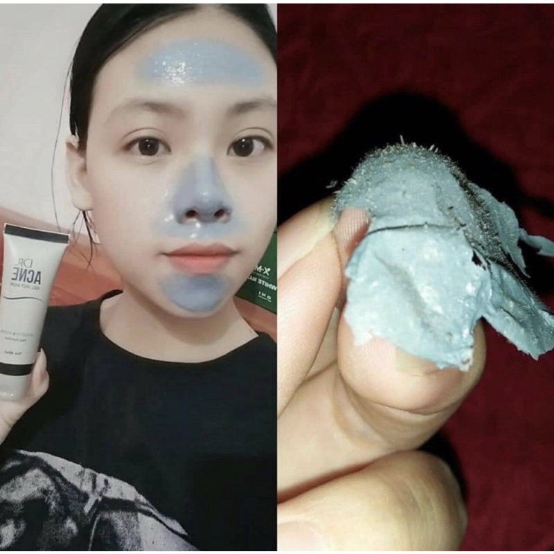 Lột mụn Acne Hải Âu Việt (hàng hot)