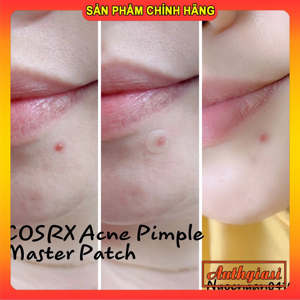 Miếng dán mụn Cosrx Ance Pimple đỏ giảm mụn sưng bọc / Clear Fit Master Patch đen che mụn tàng hình