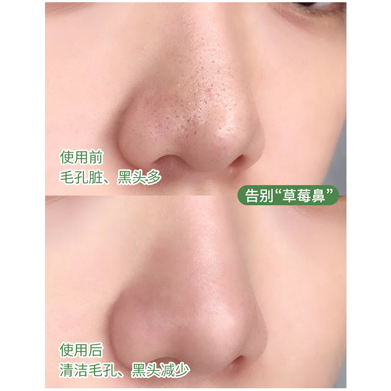 [Hàng mới về] Mặt nạ trà xanh MENGSIQI tẩy mụn trứng cá điều dầu thanh lọc trên da hiệu quả