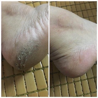 [Có bill] Chà gót chân Balea tẩy da chết chân Đức