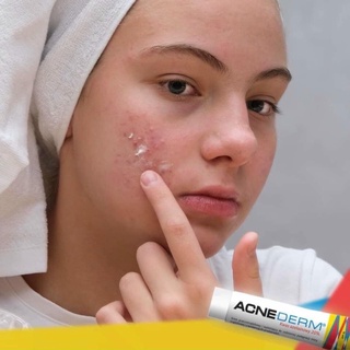 TUÝT THOA ACNE DERM
