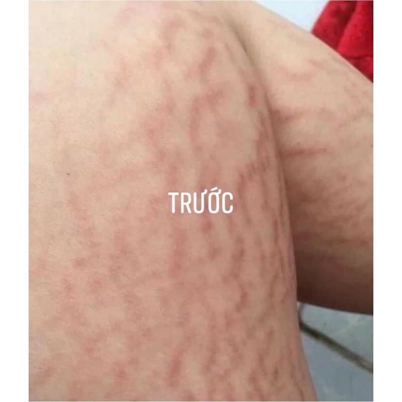 (Bill US) Kem Trị Rạn Stretcheal | BigBuy360 - bigbuy360.vn