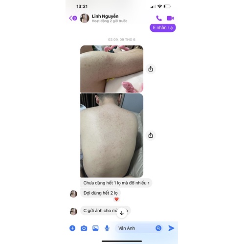 KELA LOTION DÙNG CHO VIÊM LỖ CHÂN LÔNG 30ml Thái Lan