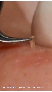 Nhíp gắp mụn 
