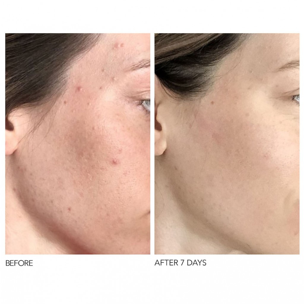 DATE 2023 Liệu Trình Tẩy Da Chết Dr Dennis Dross Alpha Beta Extra Strengh Daily Peel | BigBuy360 - bigbuy360.vn