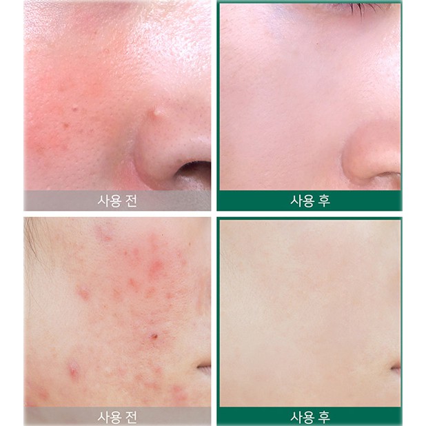 Combo giảm mụn Some By Mi AHA-BHA-PHA 30 Days Miracle (Toner + Kem)