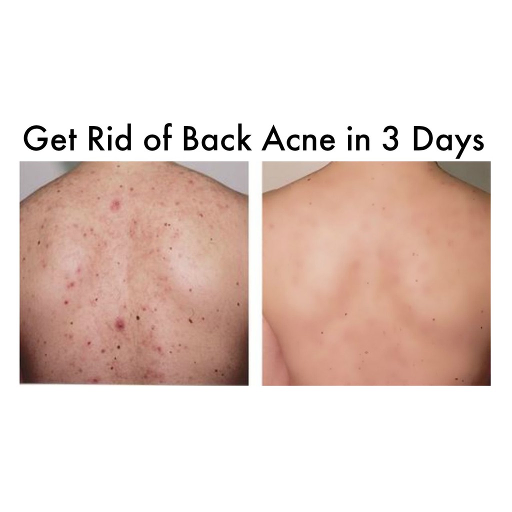 Neutrogena Xà phòng cục rửa mặt và body giảm mụn, thâm