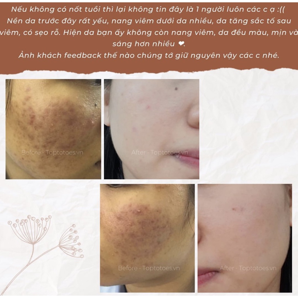 Serum Teana Anti-redness &amp; No Problem 10ml cho da mụn