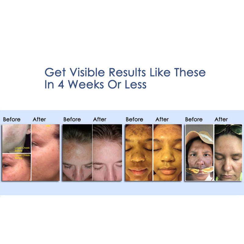 Kem dưỡng làm sáng da loại bỏ tàn nhang | BigBuy360 - bigbuy360.vn